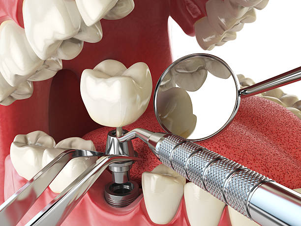 Best Emergency Wisdom Teeth Removal in Maryvle, IL